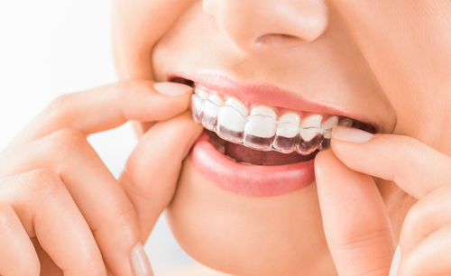 Traitement orthodontique par aligneurs
