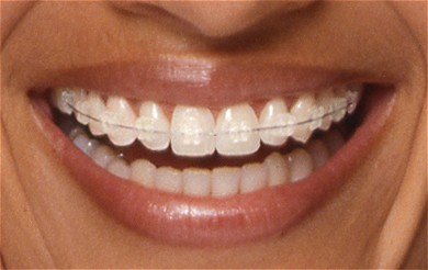 Appareil dentaire céramique