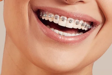 appareils dentaires métalliques