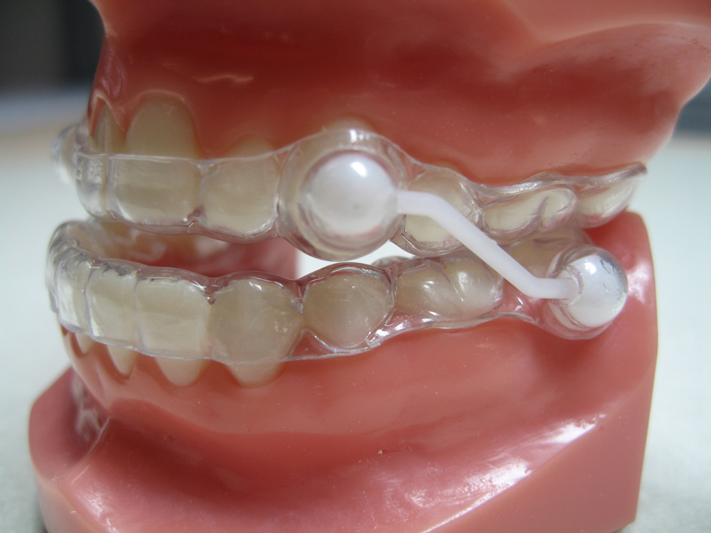 Traitement orthodontique : Le traitement de l’apnée de sommeil