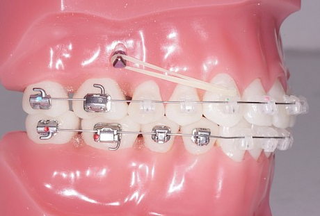 Traitement orthodontique : Mini-vis en orthodontie