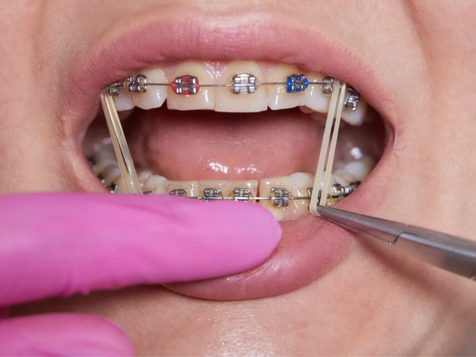 Le rôle des élastiques en orthodontie