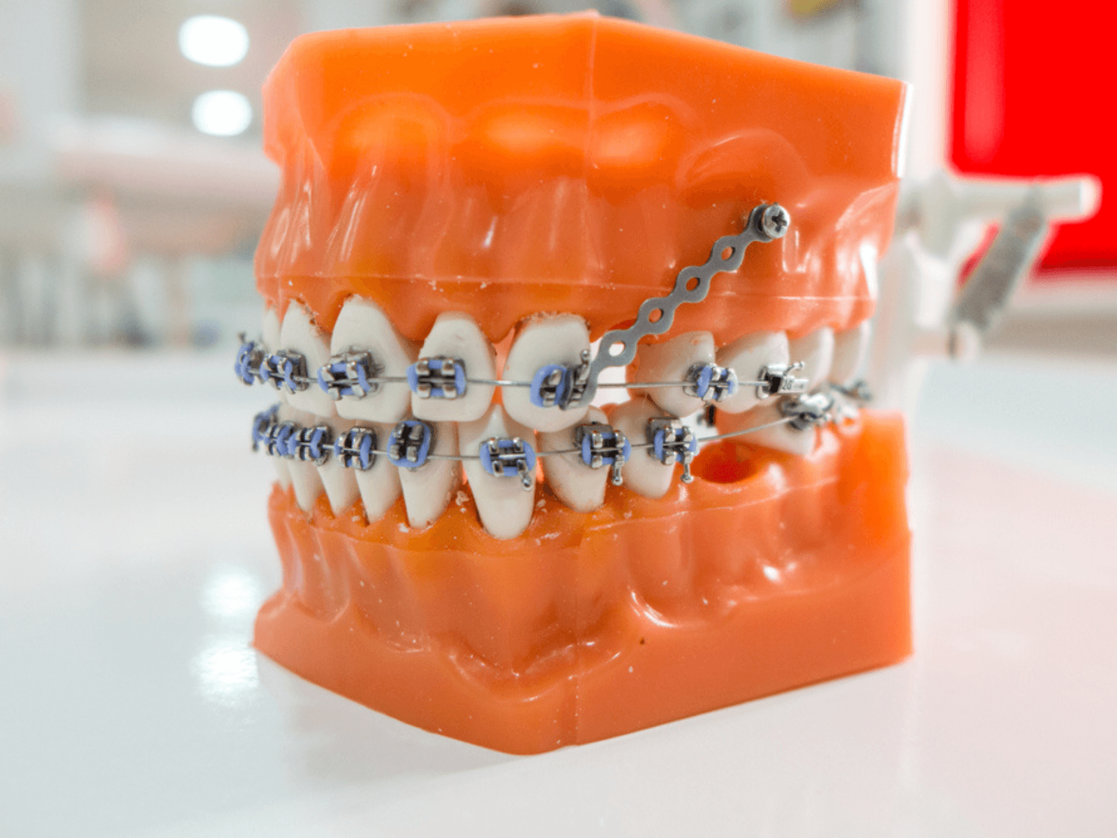 Mini-vis orthodontiques en Tunisie