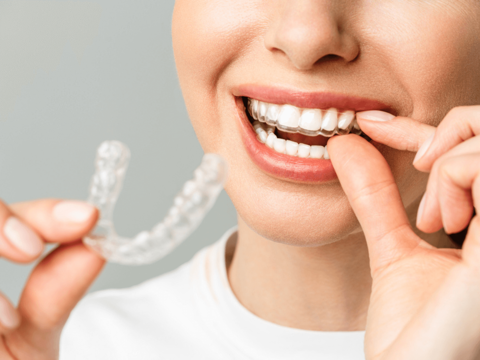 Traitement invisalign prix Tunisie - Orthodontic Studio