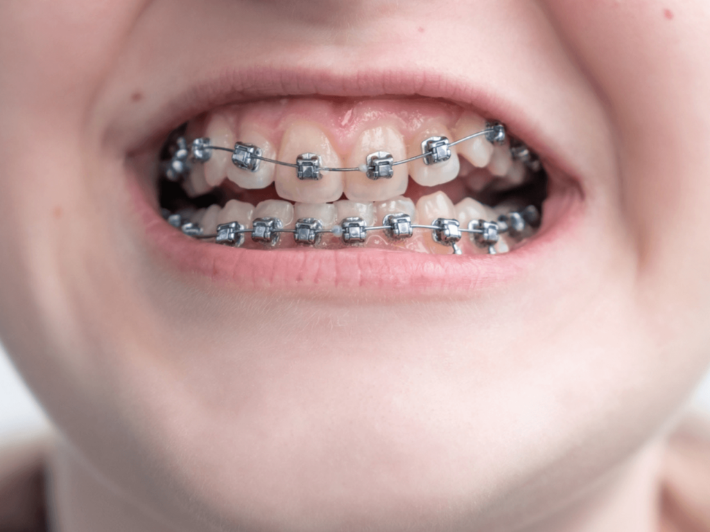 Appareils de traitement de la malocclusion dentaire en Tunisie