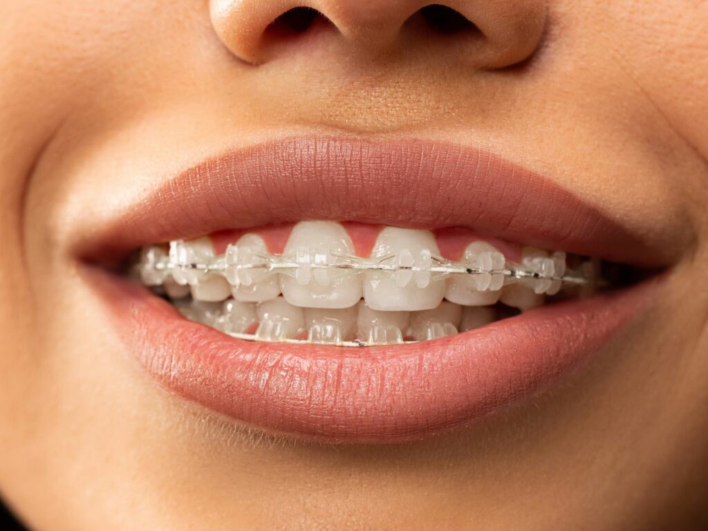 Femme souriante avec des brackets transparents sur les dents