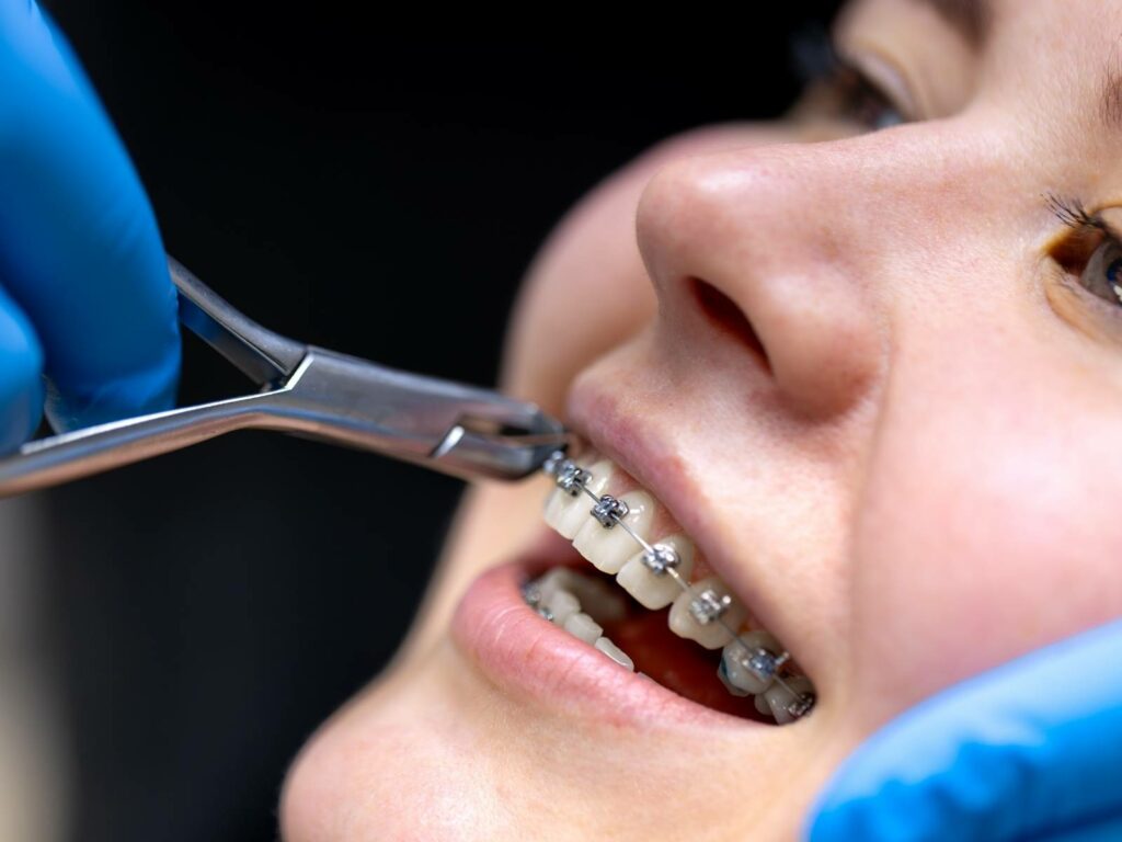 Retrait des bagues orthodontiques par une orthodontiste en Tunisie