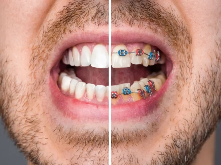 Qu&rsquo;est-ce qu&rsquo;une malocclusion dentaire et comment savoir si vous en avez une ?